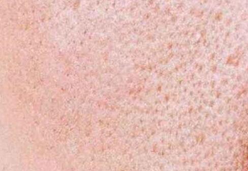 臉部毛孔粗大如何改善 幾個小妙招教給你