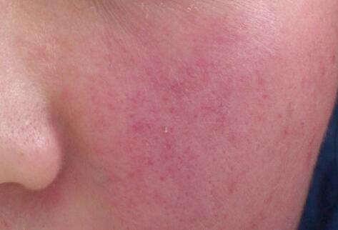 如何拯救你的敏感??？廣西南寧美容培訓(xùn)叫你正確方法