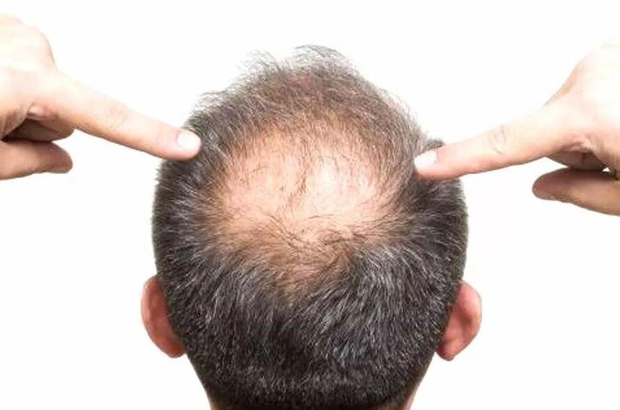 美發(fā)技巧：脫發(fā)可以用吹風(fēng)機嗎