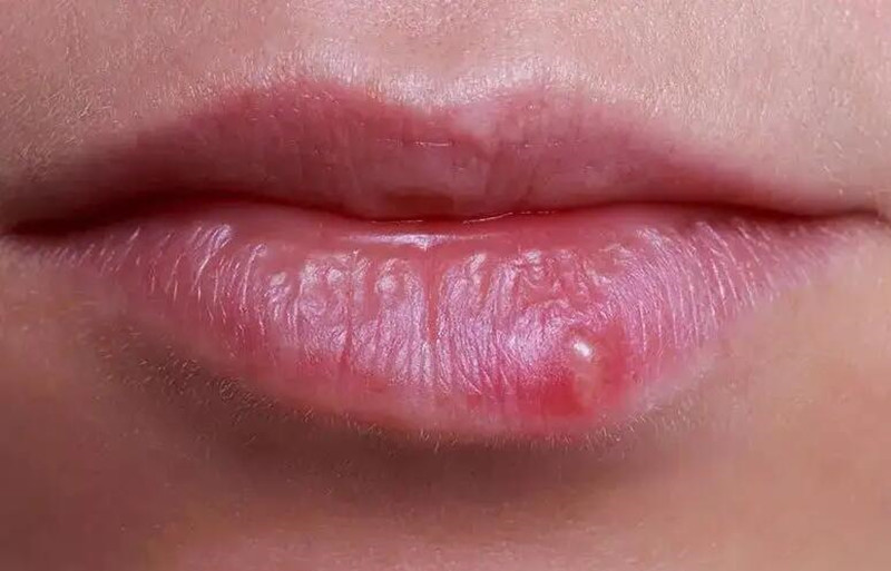 紋唇后起泡怎么辦？南寧紋唇培訓(xùn)學(xué)校教你方法